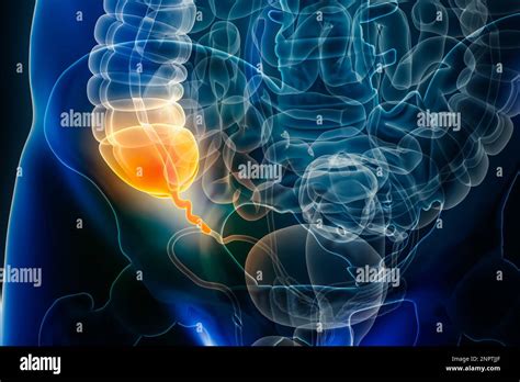 Appendicitis Disease Or Vermiform Appendix Inflammation 3d Rendering