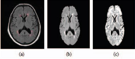 Figure 1 From Automatic Segmentation Of Multiple Sclerosis Lesions In Brain Mri Using