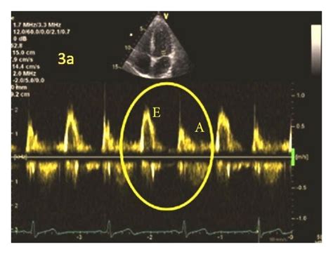 Normal Diastolic Function In Pw Doppler A Or Tdi B On The Lateral