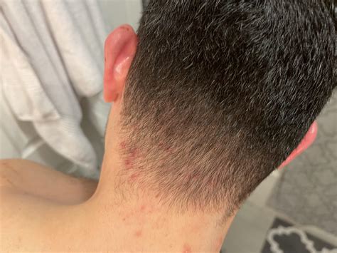 Rash On Neck At Hairline