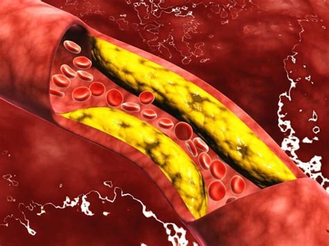 10 Causes & Common Triggers Of Fluid In Lungs (You Should Know) - OptingHealth