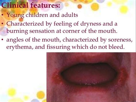 Candidiasis