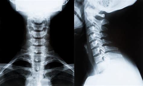 Whiplash Chiropractor Loss Of Cervical Lordosis El Paso Tx Doctor
