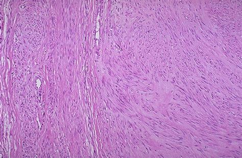 Leiomyoma; Fibroid Tumor; Fibroid Uterus; Fibroids, Uterine; Fibroma ...