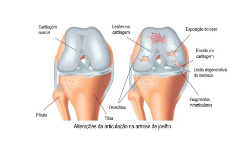 Artrose Dr Antonio Tomazini