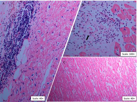 Figure From Metabolomic Profiling Of End Stage Heart Failure