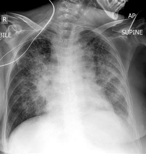 Lobar Pneumonia Chest Xray