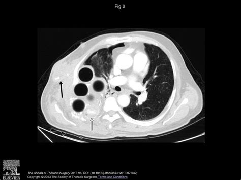 Thoracic Wall Abscess As A Late Complication Of Extrapleural Plombage