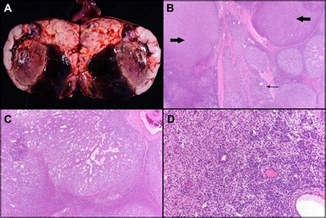 A Rare Ovarian Mixed Sex Cord Stromal Tumor In A Patient With Ollier