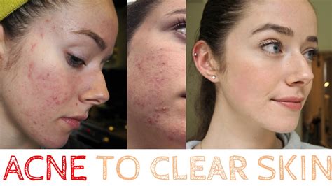 Acne To Clear Skin My Roaccutane Journey Raw Footage Youtube