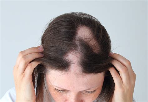 Alopecia Areata: Causes, Treatments, Breakthroughs | 2020 Guide