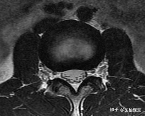 这 6 种「椎间盘突出」的影像征象别忽视！ 知乎