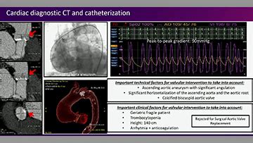 Aortic complications