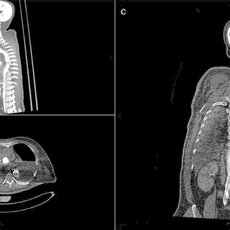 Radiological Findings The Postmortem Computed Tomography Angiography