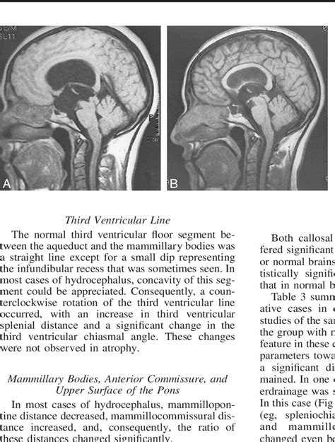 Hydrocephalus Secondary To Aqueductal Stenosis A Spin Echo Download Scientific Diagram