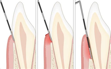 Diagn Stico Periodontal Periodontal Health Br