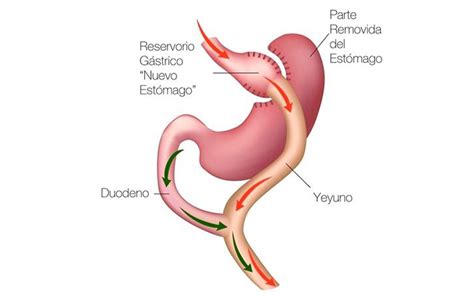 Gastric bypass with Roux-en-Y - Obesity Not 4 Me.