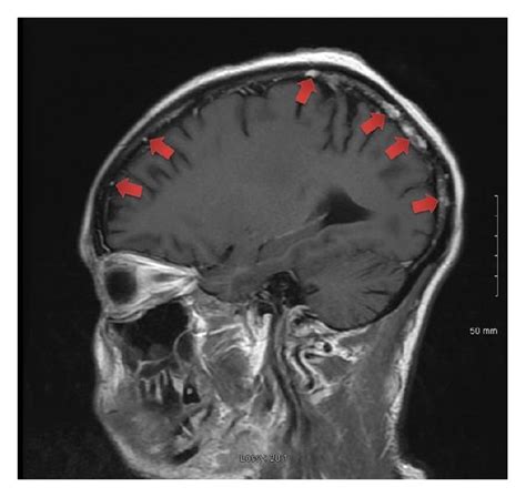 Mri Of The Brain Revealed Scattered Subcortical T2 Hyperintense Foci