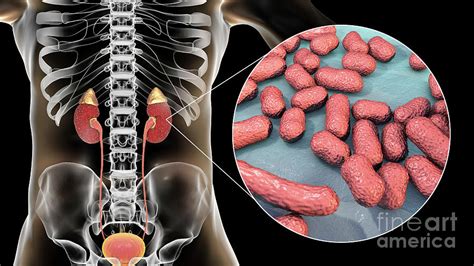 Acute Pyelonephritis Caused By Acinetobacter Bacteria Photograph By