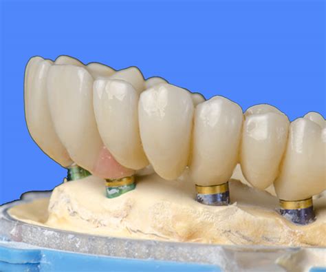 Full Arch Dental Implants | What is a dental implant?