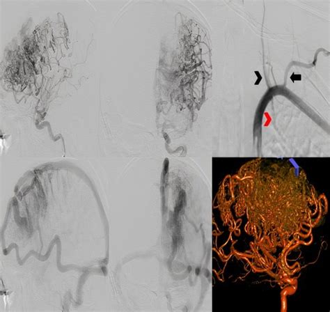 DSA Findings A Lateral And B Anteroposterior AP Arterial Phase