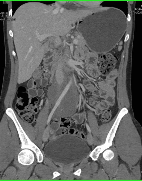 Unusual Appearance Of Retroperitoneal Fibrosis Which Simulates A