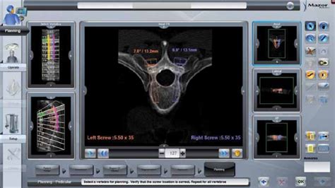 Preoperative Planning With The Software Of Renaissance Download Scientific Diagram