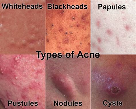 Acne • Repair & Rejuvenate Acne Skin • NASCENT Skin Clinic