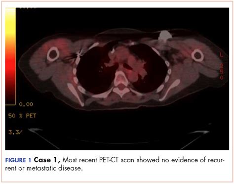 Two Cases Of Possible Remission In Metastatic Triple Negative Breast