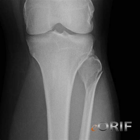 Fibula Fracture S82.409A 823.21 | eORIF