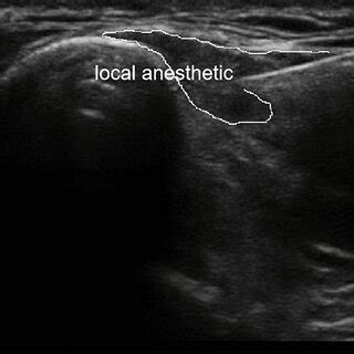 Ultrasound image of clavipectoral fascial plane block | Download ...