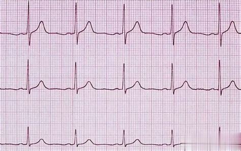 窦性心律不齐是怎么回事？如何面对窦性心律？你的心电图报告是什么样的？