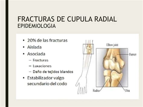 Fractura De Cupula Radial Pptx