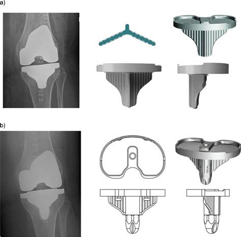 Tibial Component Designs And Radiographic Appearance A Standard