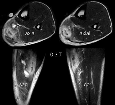 soleus muscle injury | coachingultrasound