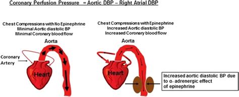 Epinephrine Use During Newborn Resuscitation Pmc