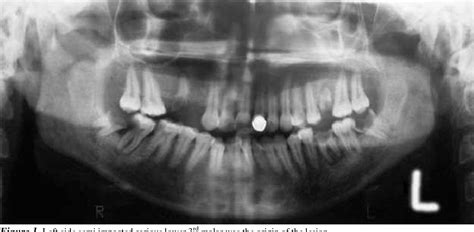 Figure 3 From Unusual Presentation Of Chronic Hyperplastic Pulpitis A