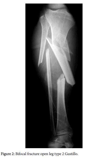 Trauma Treatment Bifocal Fracture