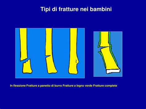 Ppt Fratture Nei Bambini Powerpoint Presentation Free Download Id 4031782