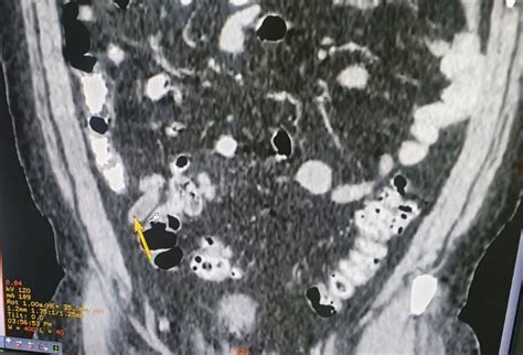 Appendicular Tuberculosis A Less Encountered Clinical Entity Bmj