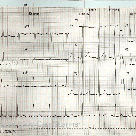 Electrocardiography Showed Sinus Rhythm Bpm Left Ventricular