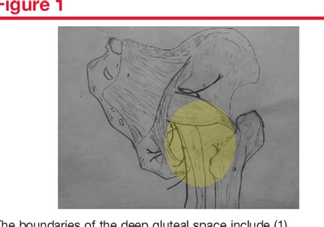 Figure 1 From Deep Gluteal Pain In Orthopaedics A Challenging