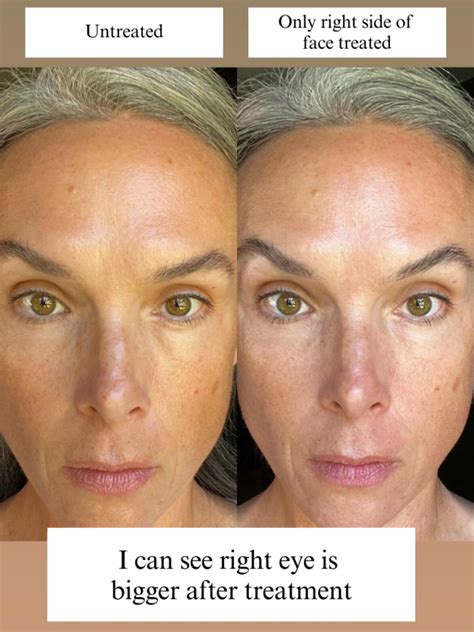 Surprising Nuface Results After 1 Day Before After Photos The New Knew