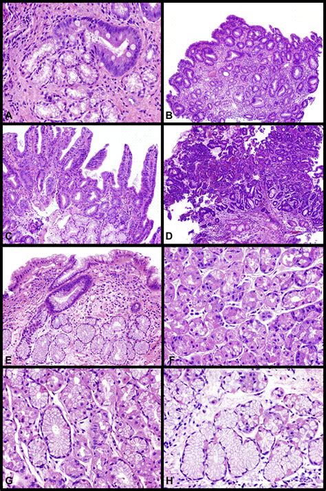 Intestinal Metaplasia Of The Gastric Cardia Findings In Patients With Versus Without Barretts