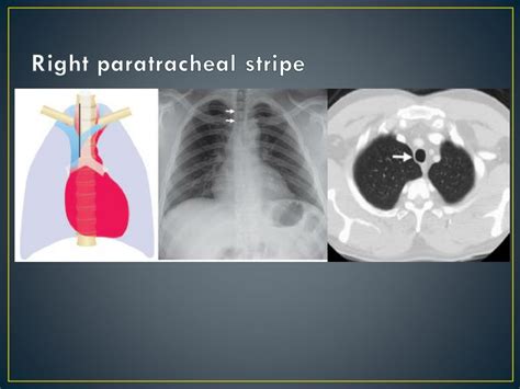 Ppt Imaging Anatomy Of The Mediastinum Powerpoint Presentation Free Download Id2075433