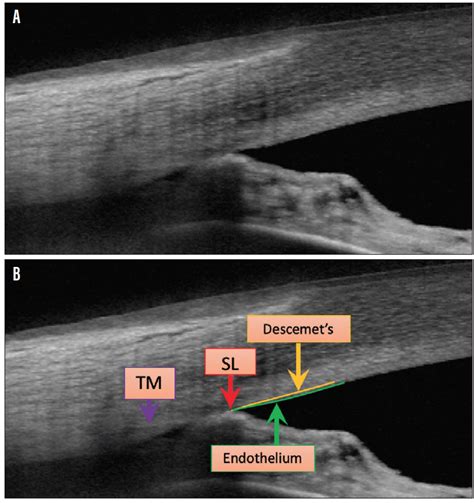 Anterior Segment OCT: Precision Angle Imaging - Glaucoma Today