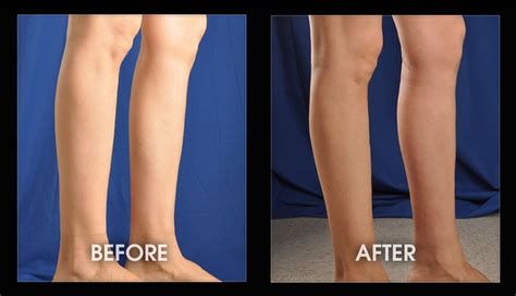 Fix Chicken Legs Male Calf Implants Long Beach Orange County