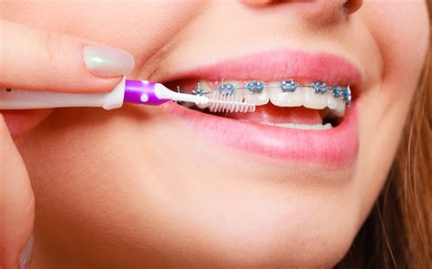 Orthodontic Problems Specialist Orthodontics Treatment Mackay