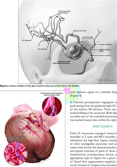 Artistic Rendition Of The End To Side Anastomosis With The Eca