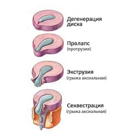 Хатха-йога: основы выздоровления при экструзии межпозвонкового диска